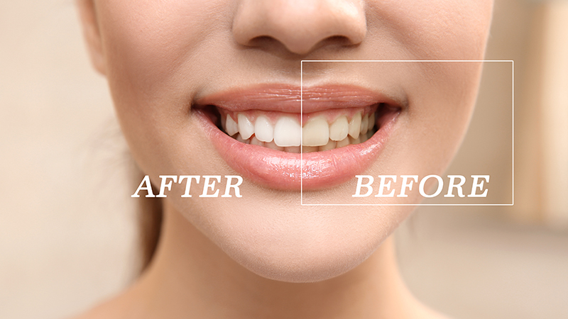 Teeth whitening Hobart IN cosmetic dentist